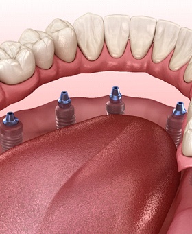 Dentures being attached to dental implant posts