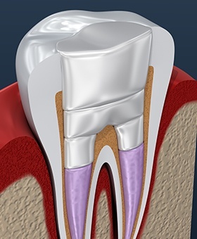 Animation of a root canal treated tooth