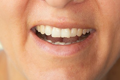 A closeup of a smile with a slightly chipped tooth
