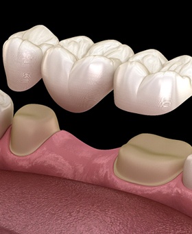 Dental bridge