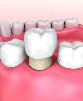 3D image of a dental crown