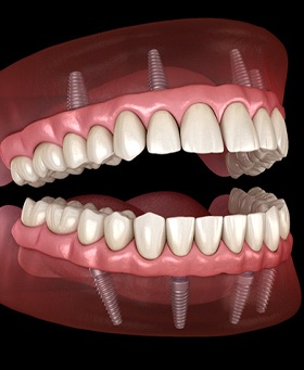 Implant-retained dentures