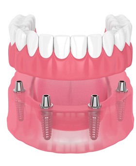 illustration of implant dentures for cost of dentures in Mangum 
  
    