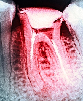 X-ray of badly damaged tooth