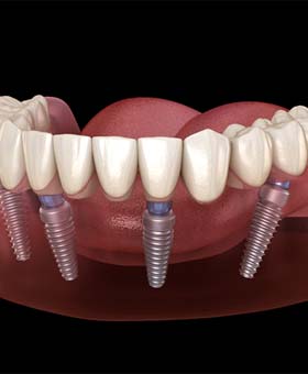 Implant denture in Mangum