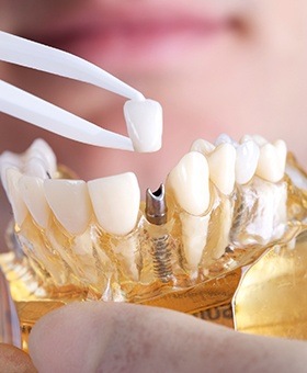 Model smile with implant supported dental crown