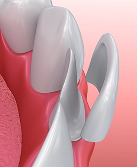 Animation of porcelain veneer placement