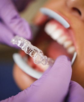 Dentist putting Invisalign trays in patients' mouth