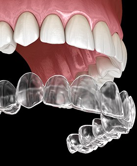 A digital image of a top row of teeth and a clear Invisalign aligner in Mangum