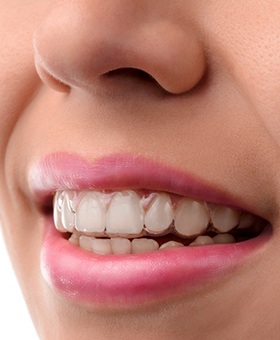 An up-close view of a person wearing Invisalign on their top row of teeth in Mangum