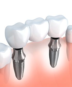 Animation of implant supported dental bridge