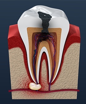 Animation of the inside of a damaged tooth