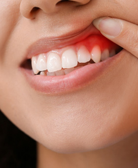 Woman pulling back upper lip to reveal dark, swollen gums