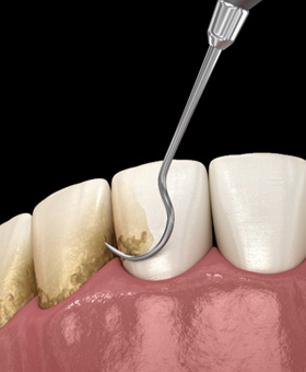 Illustration of dental instrument cleaning gums with black background