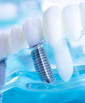 A mold that includes an implant bridge, complete with two dental implants and a customized bridge prosthetic