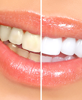 A before and after photo of a woman’s smile after having professional teeth whitening services