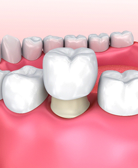 Digital image of a bottom row of teeth and a dental crown being placed over a natural tooth