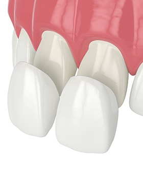 Illustration of veneers being placed on two front teeth