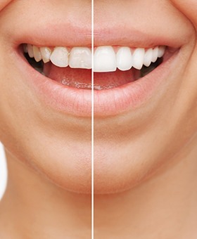 Patient's smile before and after veneers