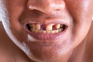 man with missing teeth