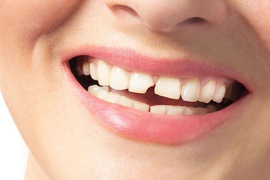 A woman with a broken front tooth